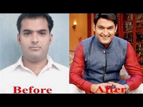 Celebrity Hair Transplant  Bollywood Celebrity Before After